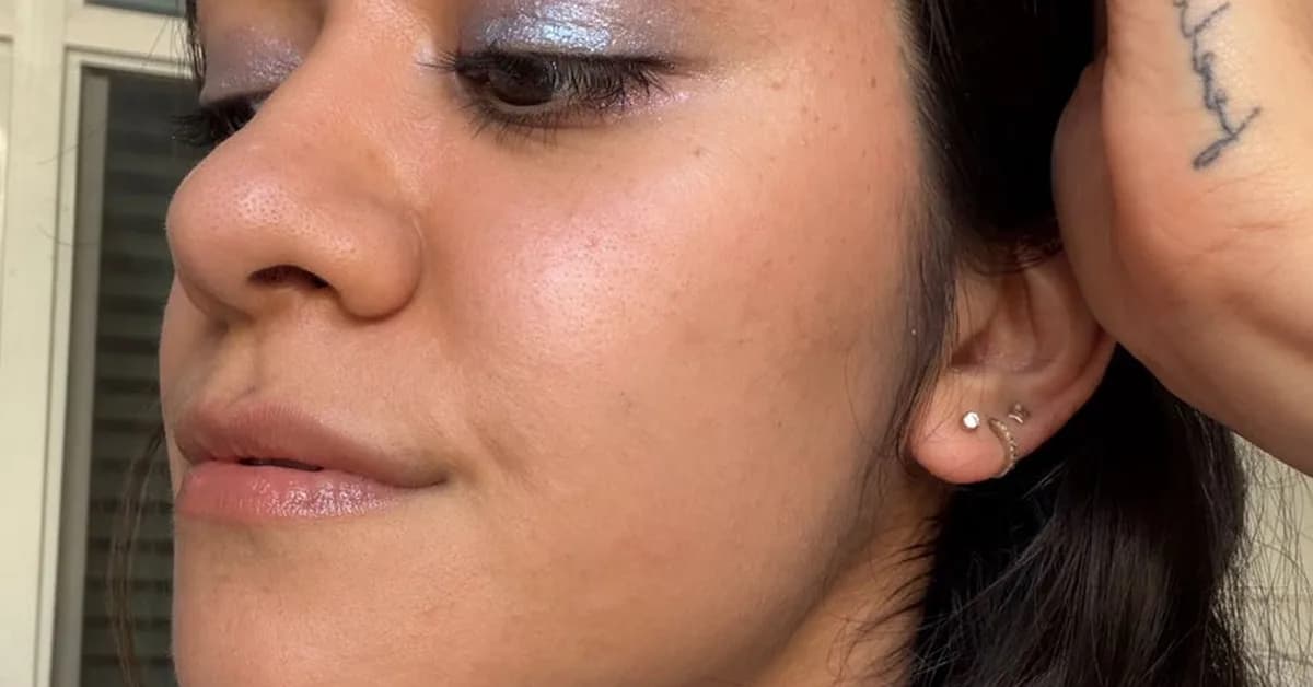 I Thought My Hyperpigmentation Was Acne Scarring - Until A Dermatologist Told Me Otherwise