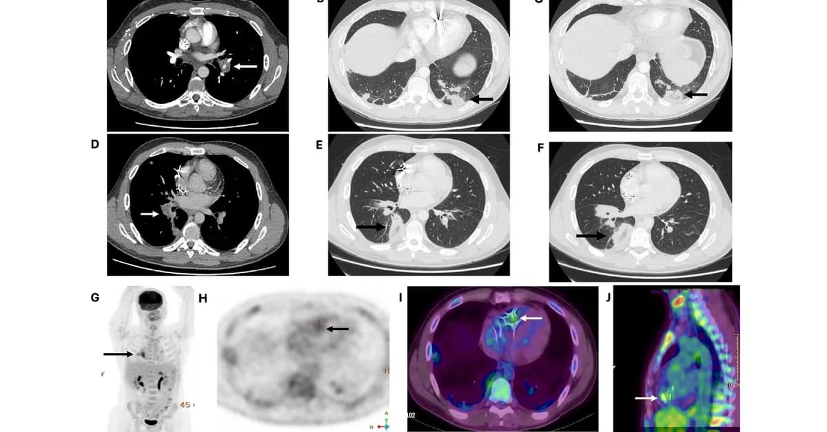 He Kept Getting Severe Blood Clots. Was It His Pacemaker?