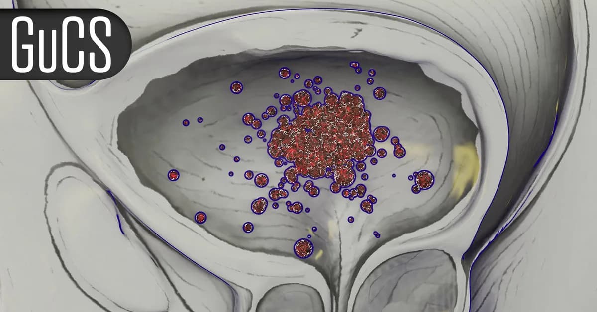 Small Study Warns on Microplastics and Prostate Tumors