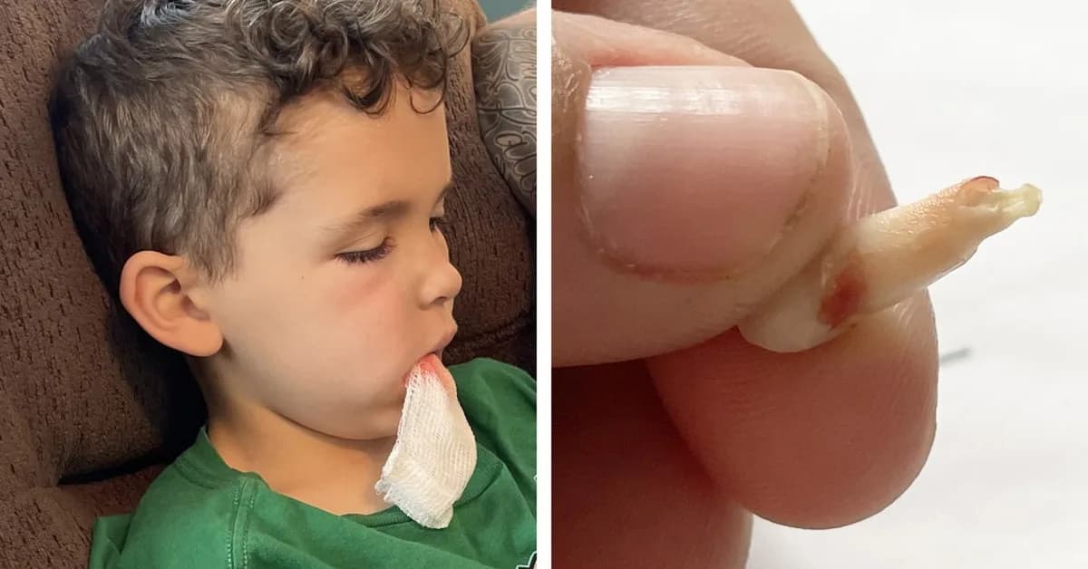 More Kids Are in ERs for Tooth Pain. Trump Cuts and RFK Jr.'s Anti-Fluoride Fight Aren't Helping.