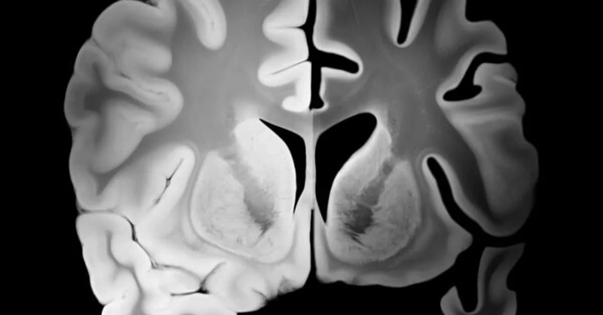 Opinion: Why do discussions about 'brain health' ignore mental illness?