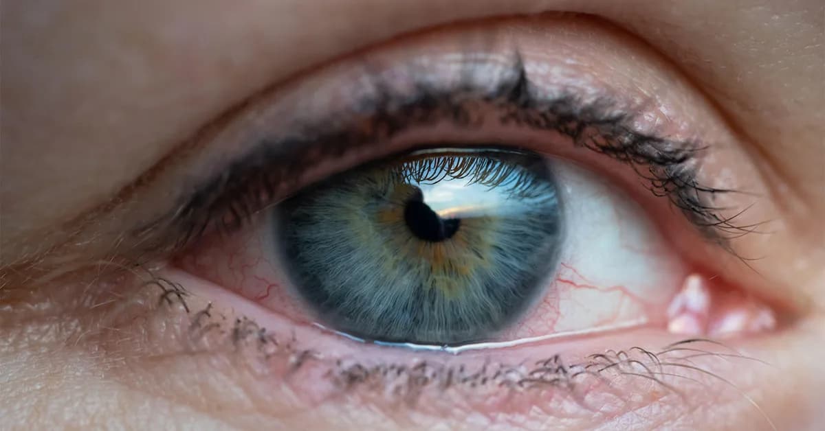 Dry Eye: Handmaiden to Many Autoimmune Conditions, Not Just Sjogren's Disease