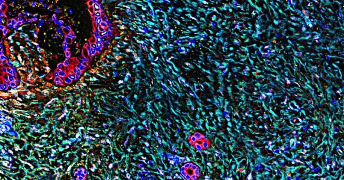 STAT+: Erasca touts strong, though preliminary, results in trial of pancreatic and lung cancer therapy
