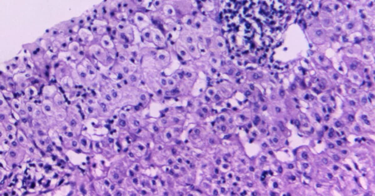 Hepatitis B vaccine rates are dropping