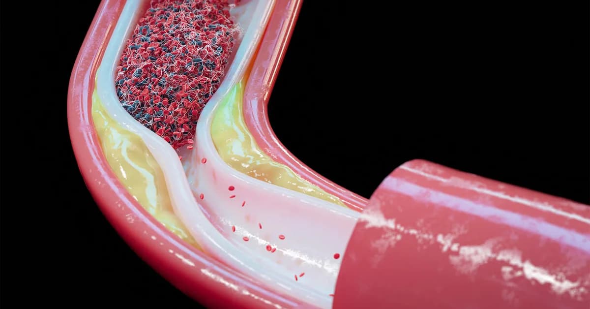 Two Types of ADT for Prostate Cancer, Different Effects on Coronary Artery Plaque