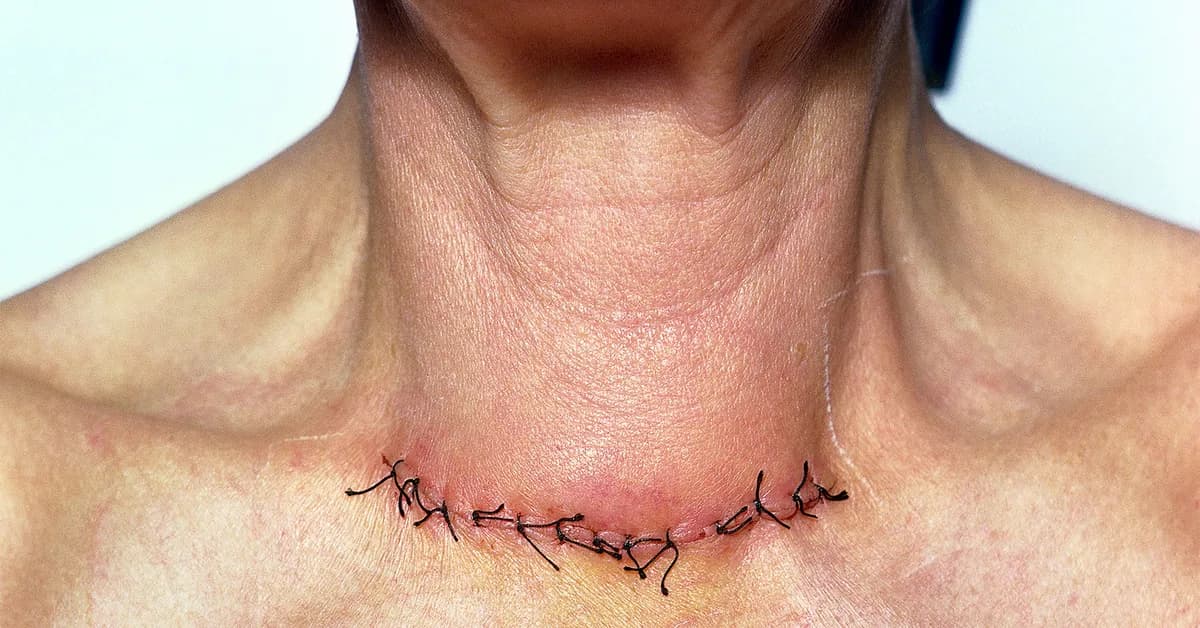 Routine Calcium After Thyroidectomy? Clinical Trial Challenges Practice