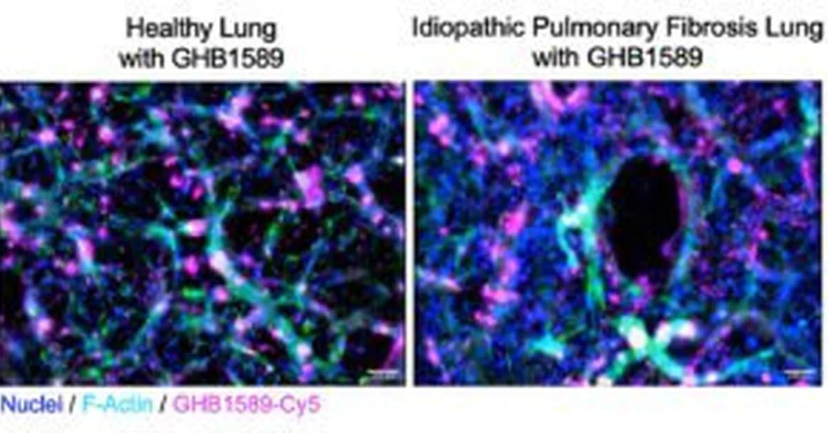 Rewriting Disease: Oligonucleotides Take Aim at the Untreatable