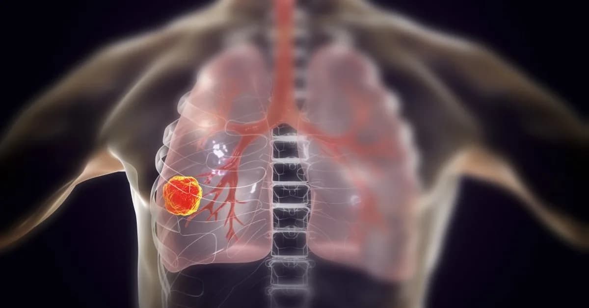Cancer Immunotherapy Improved Using Targeted Stress Protein