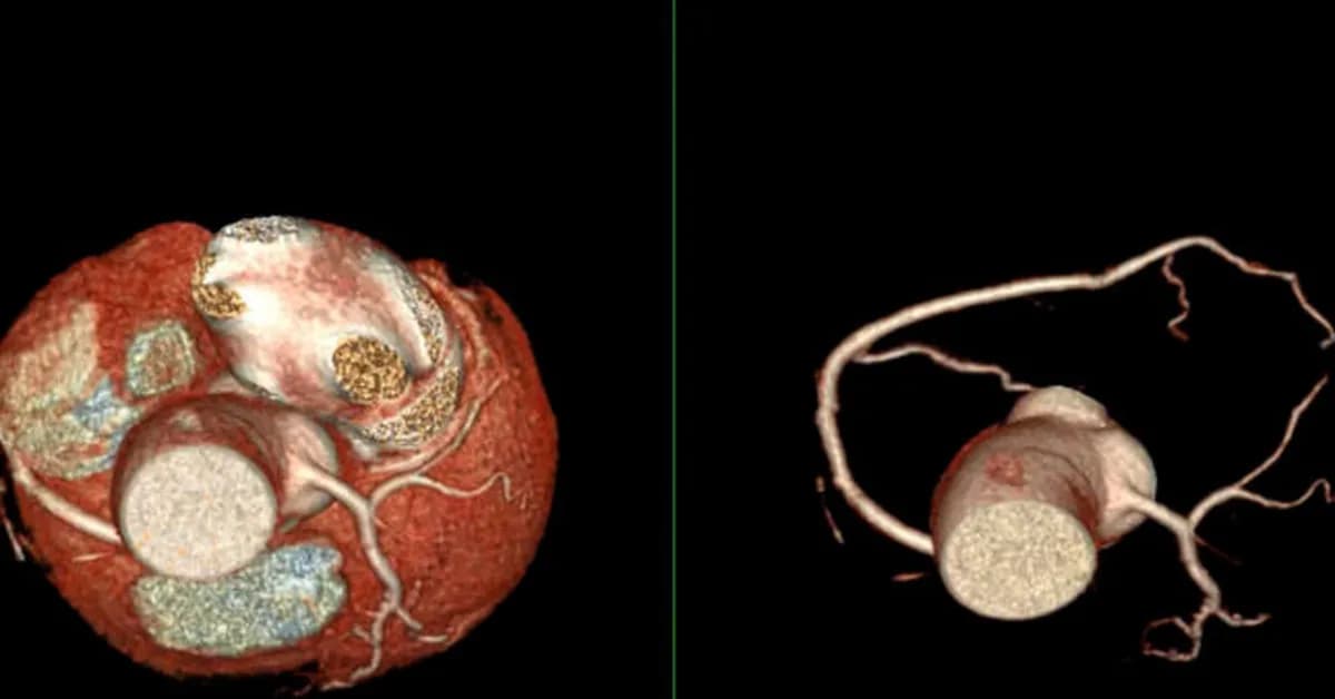 Women's heart attack risk rises even if arteries aren't as clogged as men's
