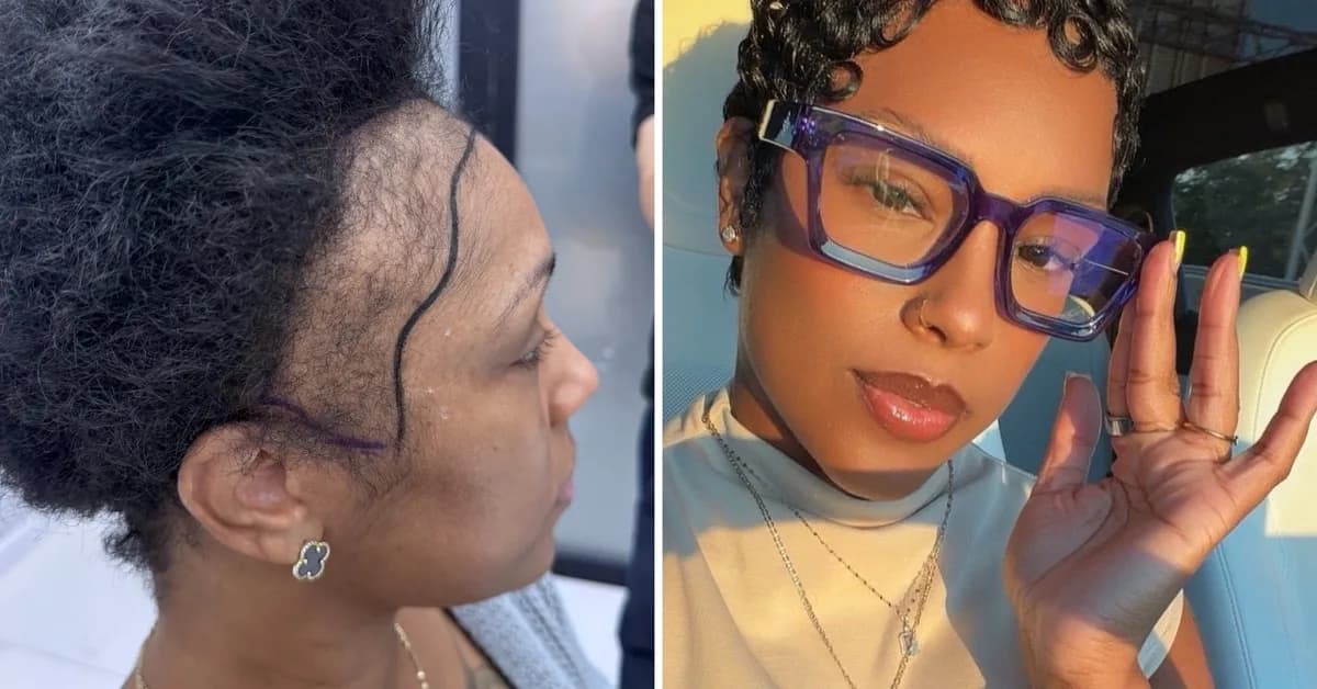 I couldn't afford a $13,000 hair transplant in the US. So I flew to Turkey and I love the results.