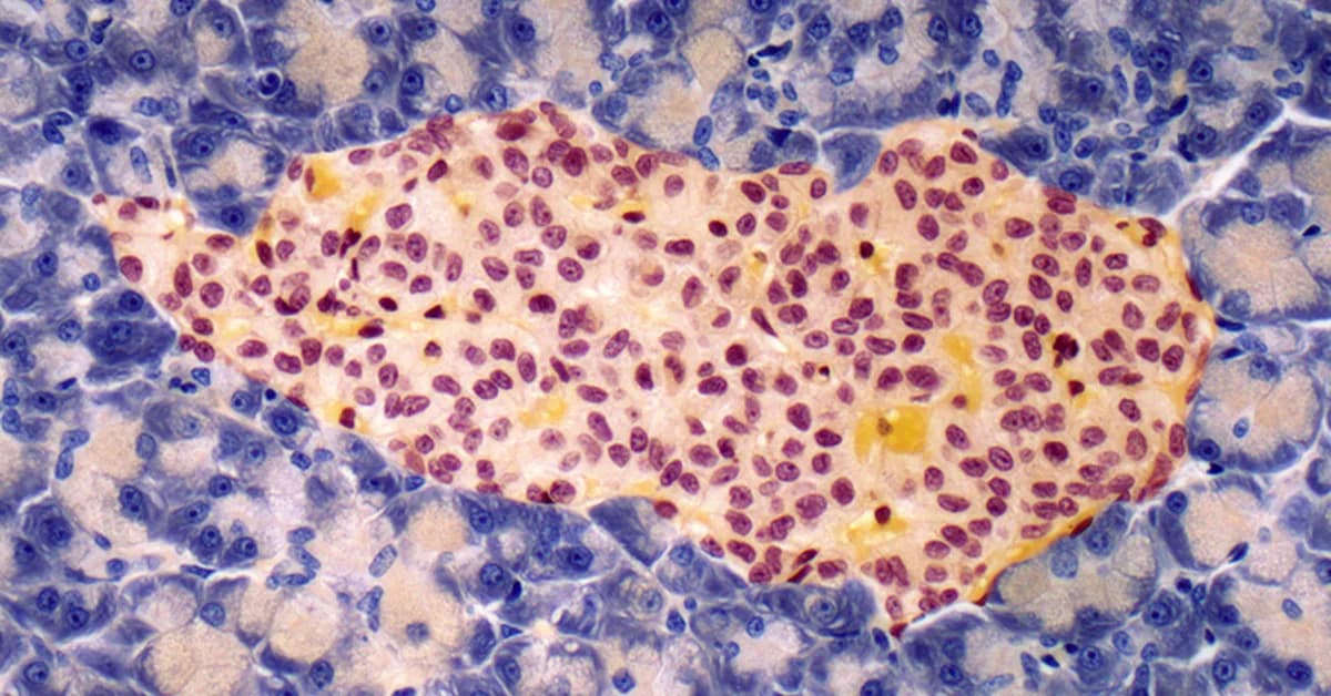 Electronic Mesh Spurs Islet Cell Maturation, Could Aid Diabetes Care