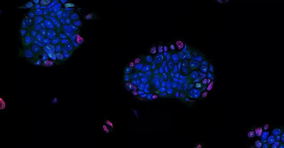 Patient-Derived Tumor Organoids Show Promise for Personalizing Cancer Treatment
