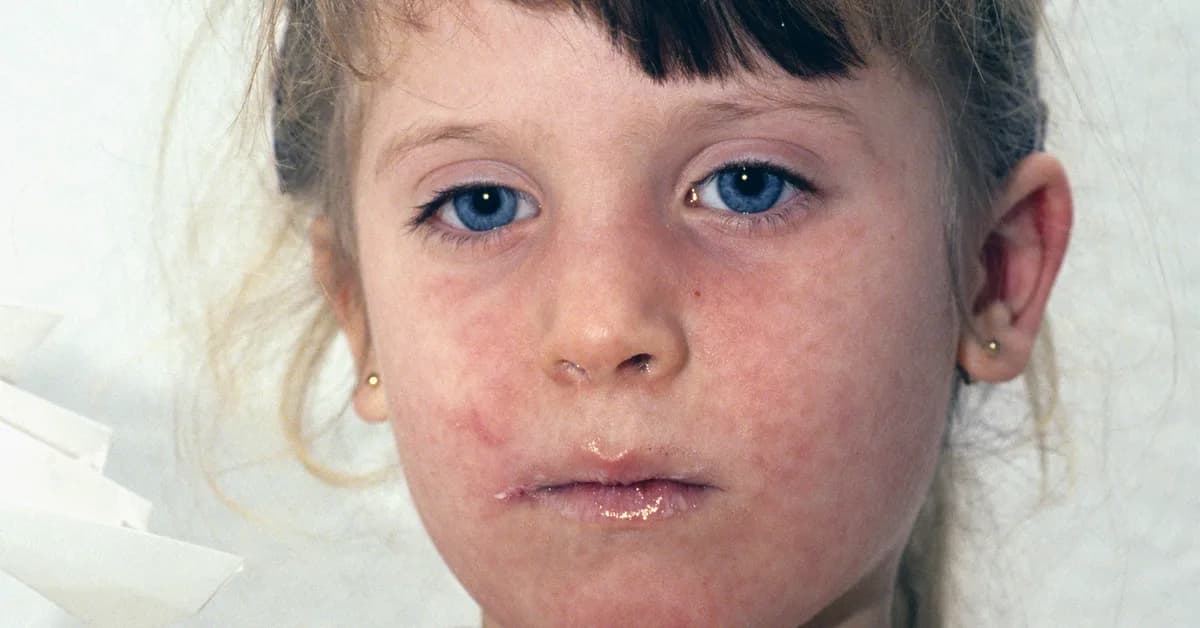 As Measles Cases Pass 1,000 for the Year, Experts Urge Vaccination