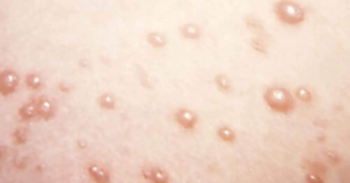 In rare chickenpox case, itchy blisters mushroom into large, rubbery nodules