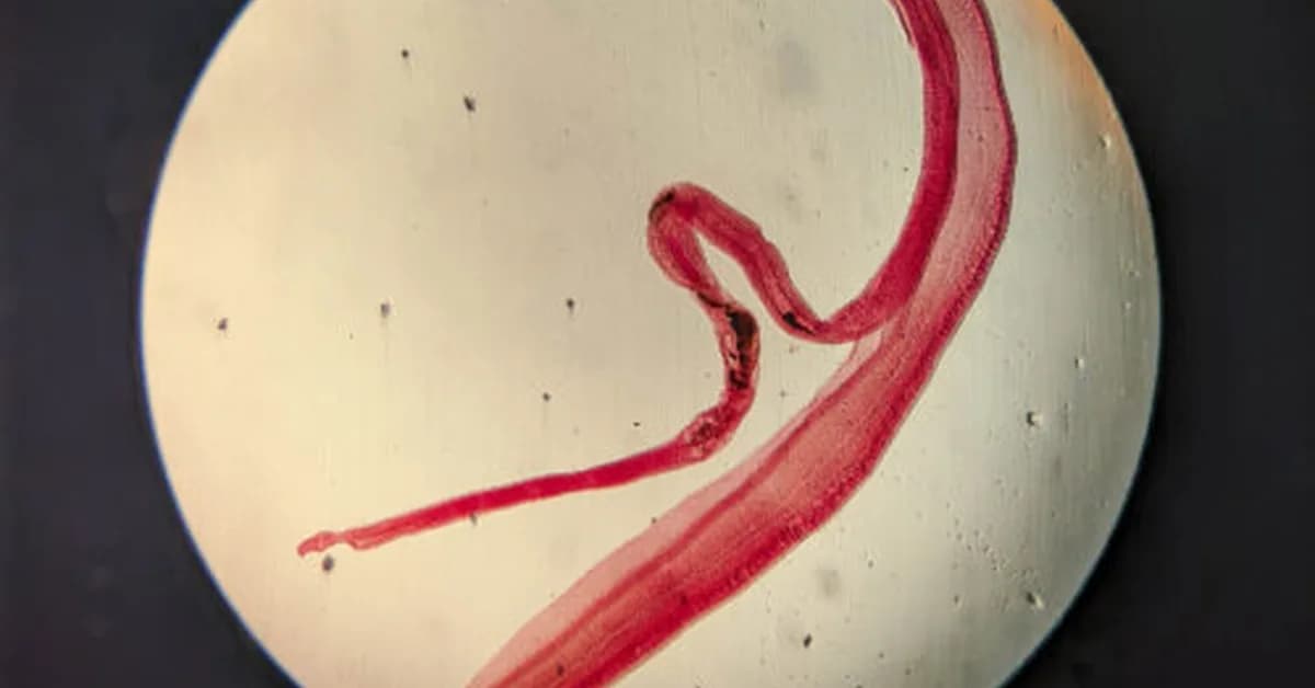 Woman's brain worm infection confirmed after eggs grow tails in lab test