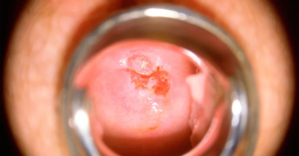Cervical Precancers Linked to Increased Heart Risks