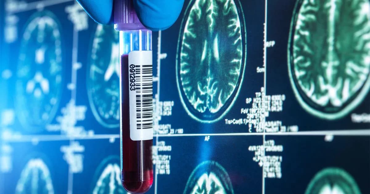 Alzheimer's 'Clock' Uses Blood Test to Forecast Symptom Onset